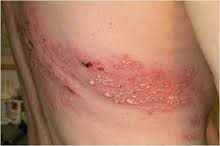 Illustration for article titled pengobatan herpes dengan lidah buaya